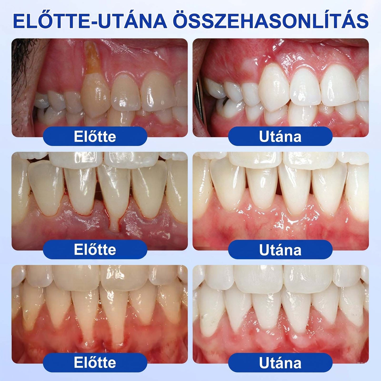 Evolvion® 🦷 GumRevive Ínyregeneráló Gél – Az egészségesebb ínyért és magabiztosabb mosolyért 👍