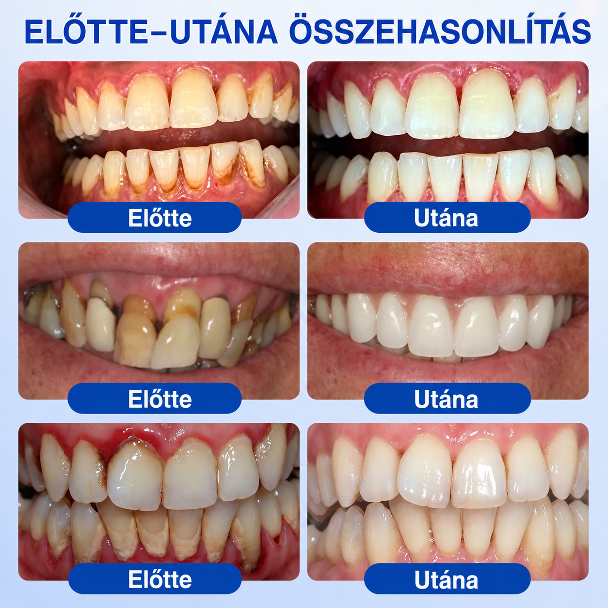 🇭🇺👨‍⚕️✅🦷 HEATWOLF® GumRevive – Parodontális helyreállító gél🍿