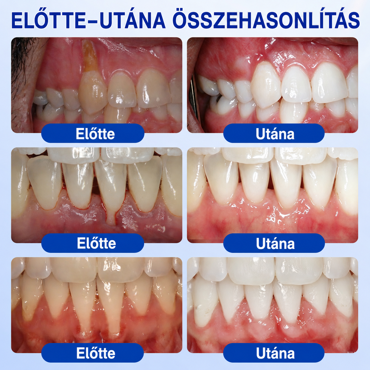 🇭🇺👨‍⚕️✅🦷 HEATWOLF® GumRevive – Parodontális helyreállító gél🍿
