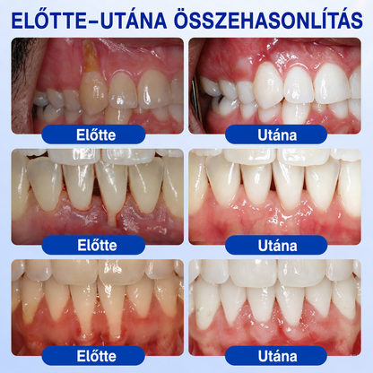 🇭🇺👨‍⚕️✅🦷 HEATWOLF® GumRevive – Parodontális helyreállító gél🍿